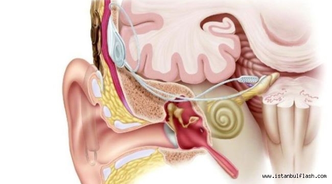 40 çocuğumuz, sessizlik içinde beyin sapı implantı ameliyatı bekliyor!